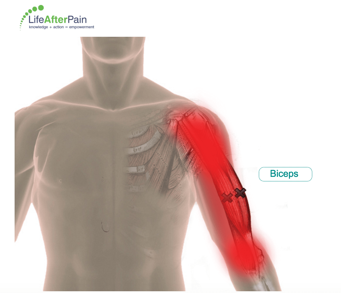 Trigger Points & Arm Pain