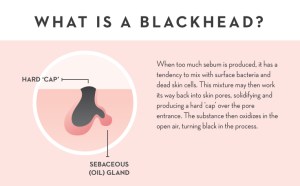 what is a blackhead