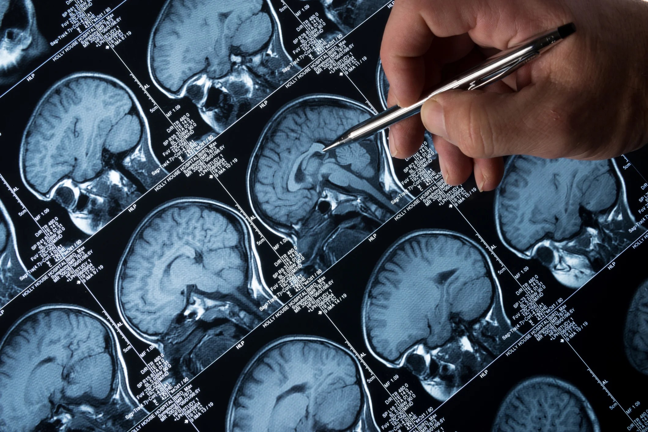 Alzheimer’s ‘wonder drug’ slows progression of disease by four years – and could even reverse it Alzheimer’s ‘wonder drug’ slows progression of disease by four years – and could even reverse it