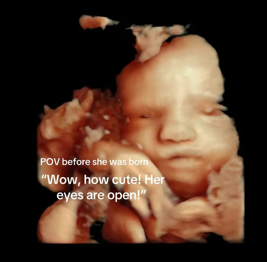 Rare neurological disorder leaves baby girl unable to blink or smile Rare neurological disorder leaves baby girl unable to blink or smile