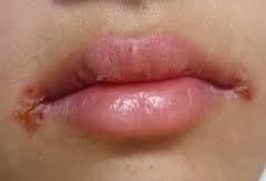 口角炎の原因は何ですか?