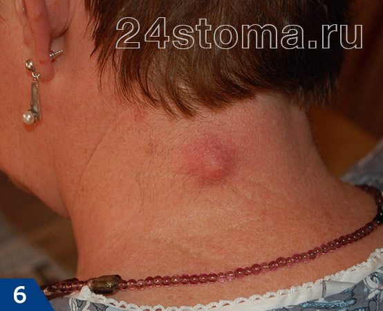 Лечение чирия народными средствами: основные методы. Как лечить фурункул в домашних условиях быстро