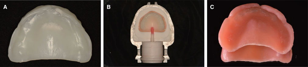 Denture Base Biology  - Abe Suction Denture Is The Atmospheric Denture Fabrication Technique For The.