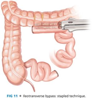 In blind loop syndrome a portion of the small intestine becomes bypassed and thus cut off from the normal flow of food. Strictureplasty and Small Bowel Bypass in Inflammatory