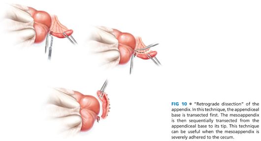 Appendectomy: Open Technique | Abdominal Key