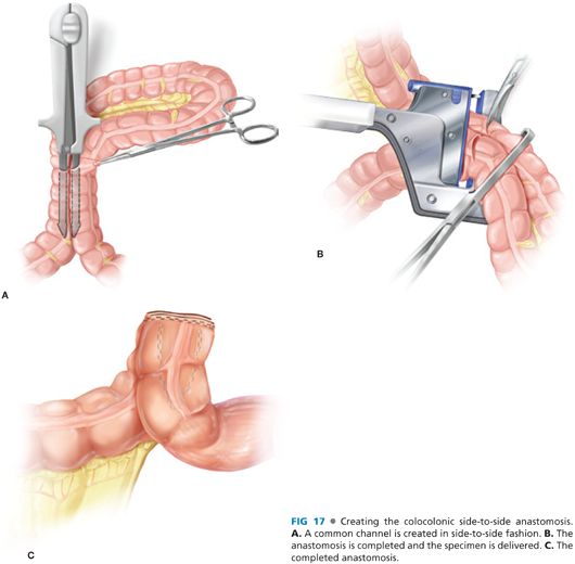 Total Abdominal Colectomy: Open Technique | Abdominal Key