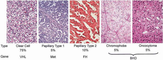 Rcc Types Surgical and Medical Options in the Management of Renal Cell Carcinoma ...