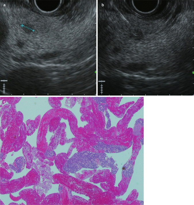 EUSGuided Interventions Indications, Contraindications, and Risks