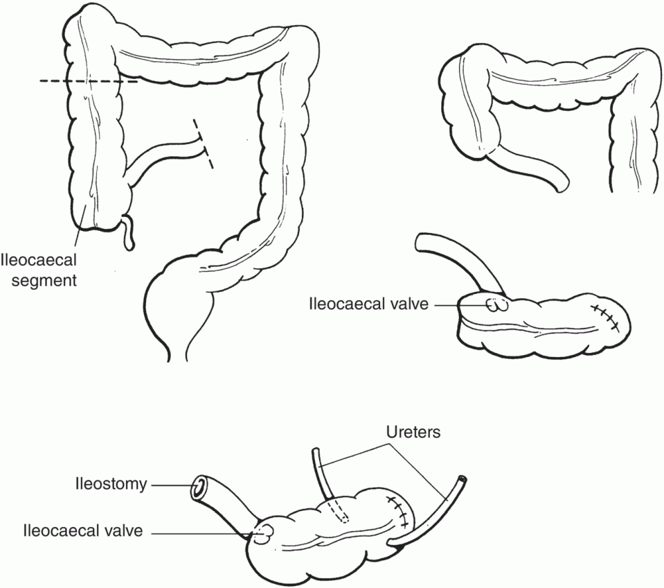 Urinary Diversion | Abdominal Key