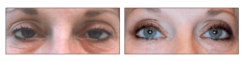 Skin & laser dermatology center treats patients for all skin care concerns, including skin cancer surgery, cosmetic dermatology, sclerotherapy, laser peels, laser hair removal, hyperhidrosis, rosacea, and acne treatments. Fat Deposit Removal - Ablon Skin Institute - Dr. Glynis Ablon, M.D., F.A.A.D.