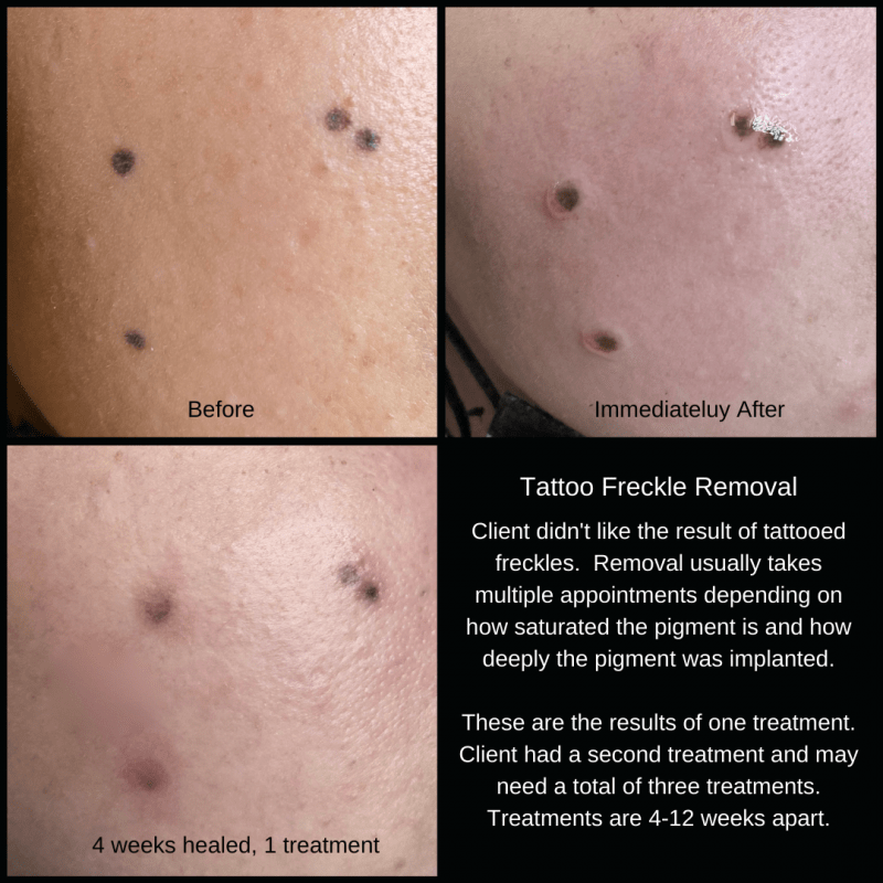 Tattoo Removal & Permanent Makeup Correction Results – About Face And Body 800_x_800_png