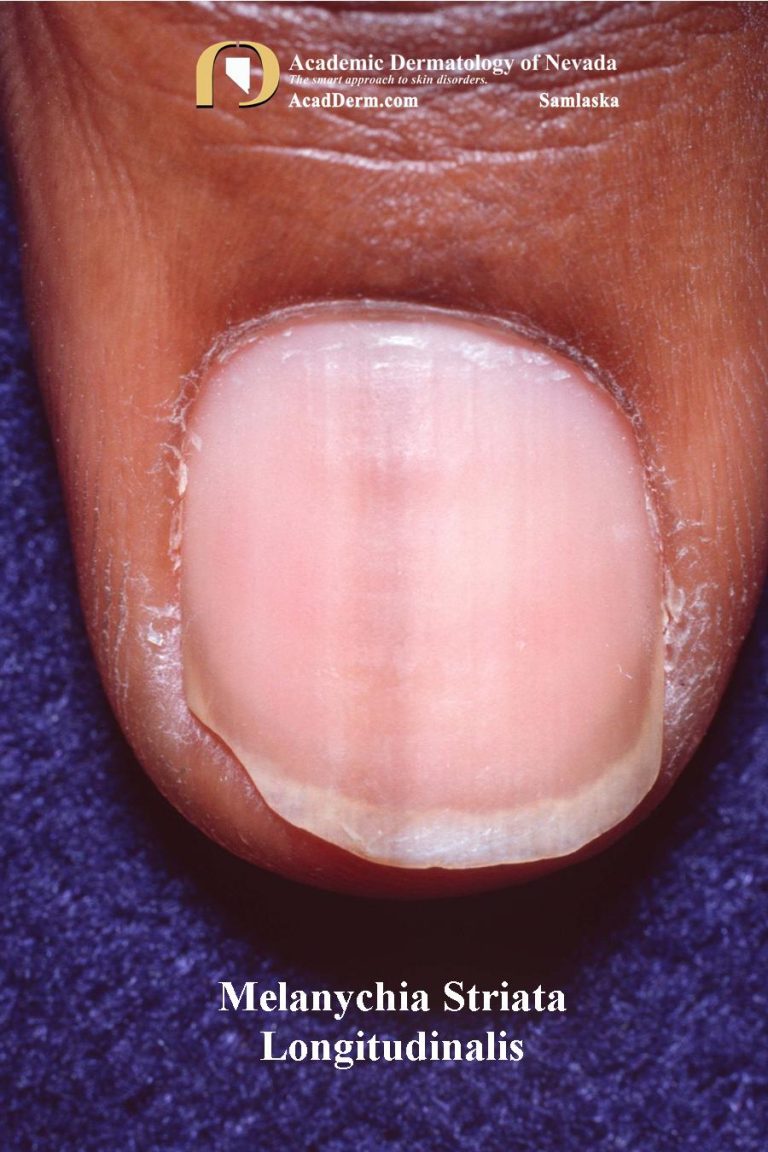Nails come in a variety of sizes to suit a variety of jobs around the house. Melanonychia Striata Longitudinalis (MSL): Pigmented bands