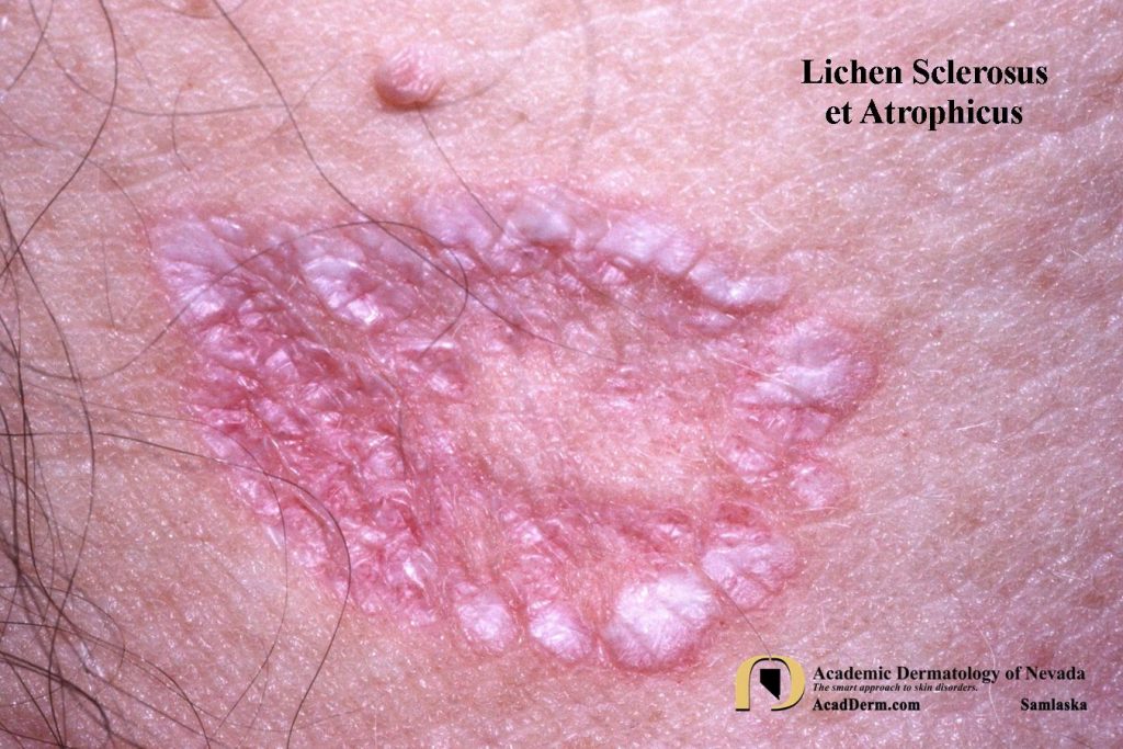 Anthracite is a type of coal that is used to fuel power stations in the process of generating electricity. Lichen Sclerosus: Lichen Sclerosus et Atrophicus