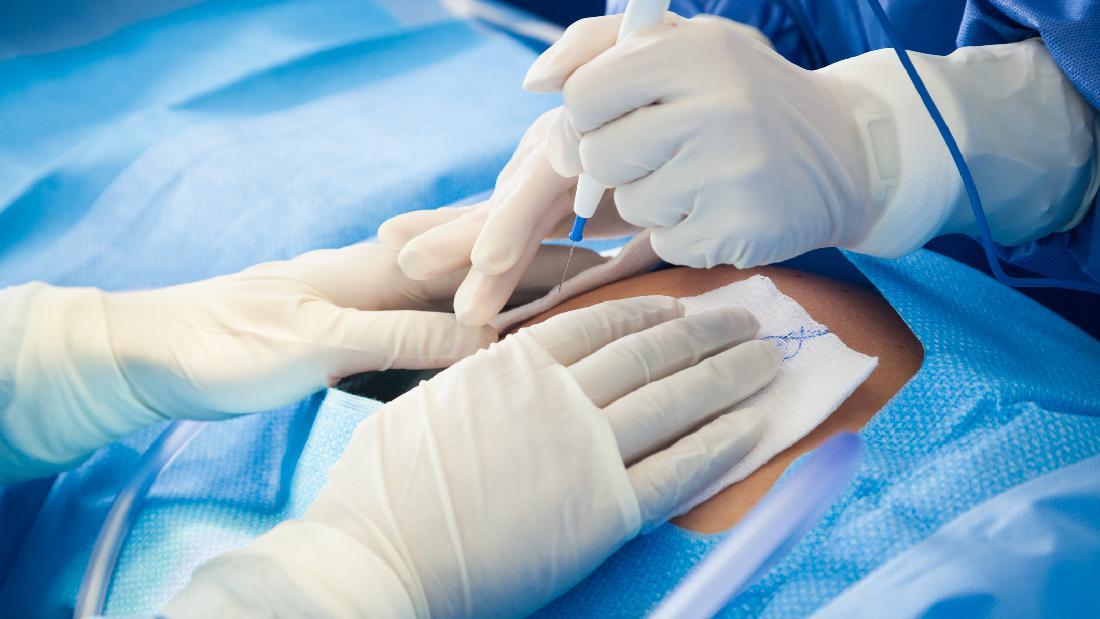 Luka Caesar Merah hingga Bernanah, Apa yang Harus Dilakukan?