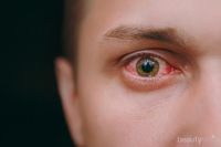 Penglihatanmu Tiba-tiba Kabur? Ini Penyebab dan Cara Mengatasinya!