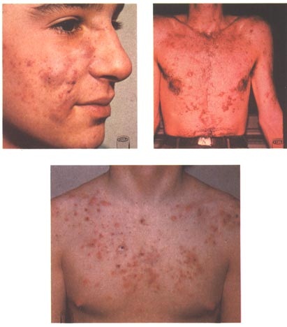 Ce este acneea * principalele tipuri * cauzele acneei * tratamente moderne. Cosuri Pe Fata Cu Puroi Despre ViaÈa Din Romania