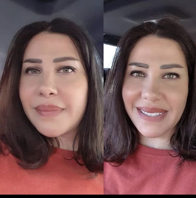 أصالة قبل وبعد التجميل حليمة بولاند قبل وبعد التجميل. Ø´Ù‚ÙŠÙ‚Ø© Ù†Ø§Ù†Ø³ÙŠ Ø¹Ø¬Ø±Ù… Ø§ØµØ¨Ø­Øª Ø§Ø³ÙˆØ£ Ø¨Ø¹Ø¯ Ø§Ù„ØªØ¬Ù…ÙŠÙ„ ØµÙˆØ± Ù…Ø¬Ù„Ø© Ø§Ù„Ø¬Ø±Ø³