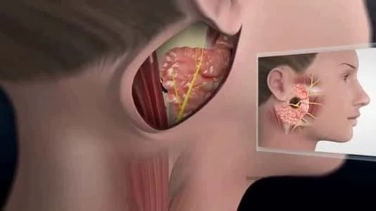 من هم الأكثر عرضة للإصابة بالغدة النكافية؟ إليك الإجابة الطبية