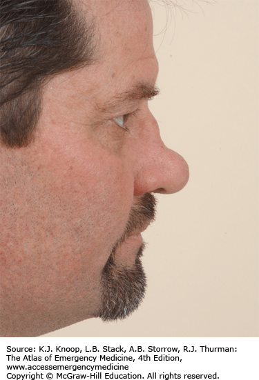 Congenital syphilis can present during childhood with a number of systemic features, including hutchinson's teeth, saddle nose deformity and . HEAD AND FACIAL TRAUMA | Anesthesia Key
