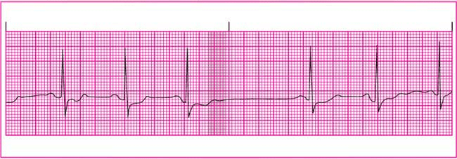 Paroxysmal supraventricular tachycardia (psvt) is an abnormally fast heart rate that seems to be occurring for no reason. Atrial arrhythmias | Anesthesia Key