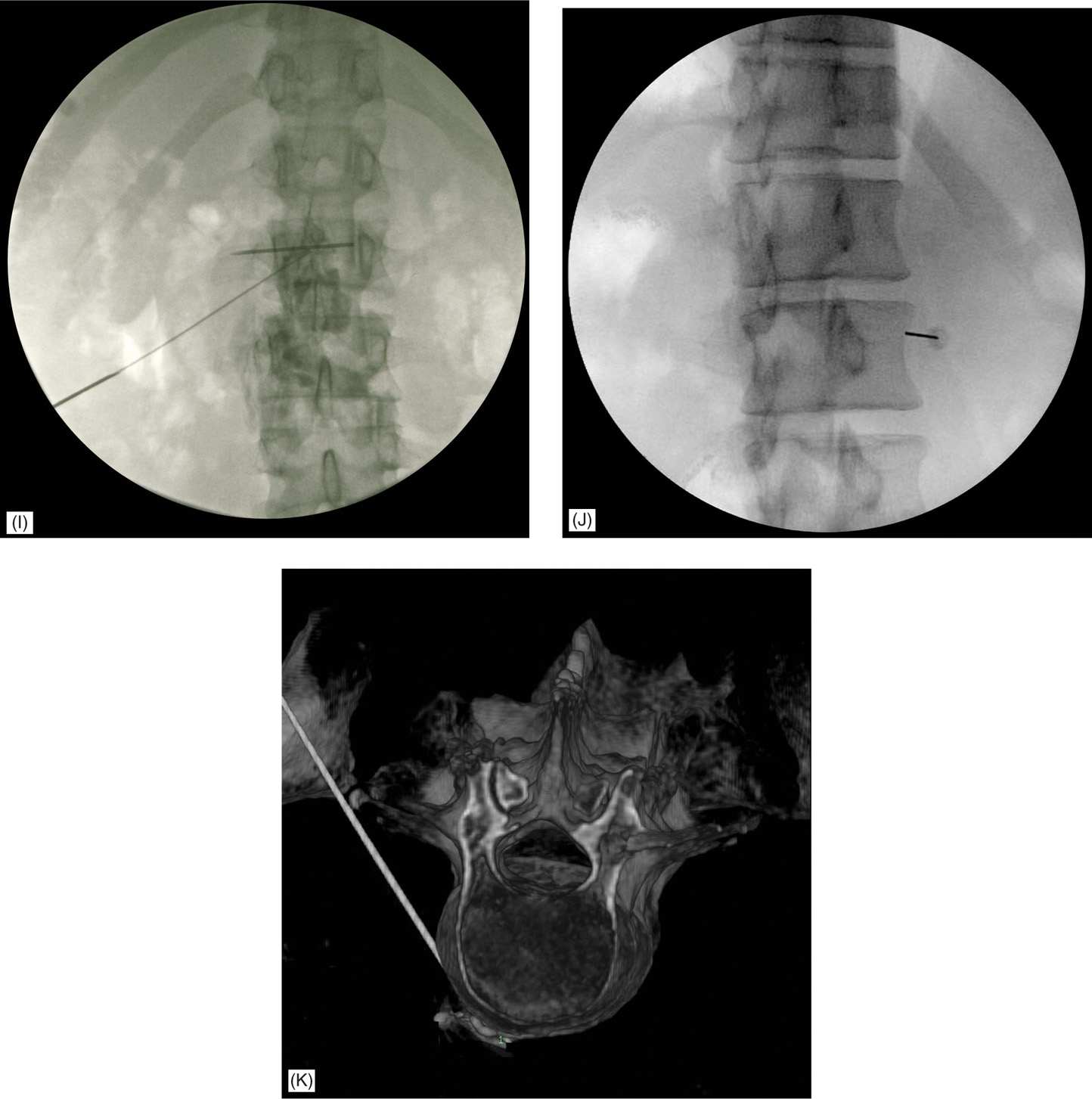 Lumbar Sympathetic Block Anesthesia Key