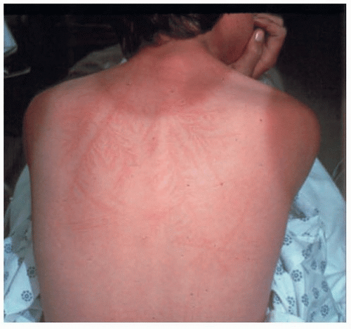 Lightning Strike Rash Management of Lightning Injuries and Severe Storms | Anesthesia Key