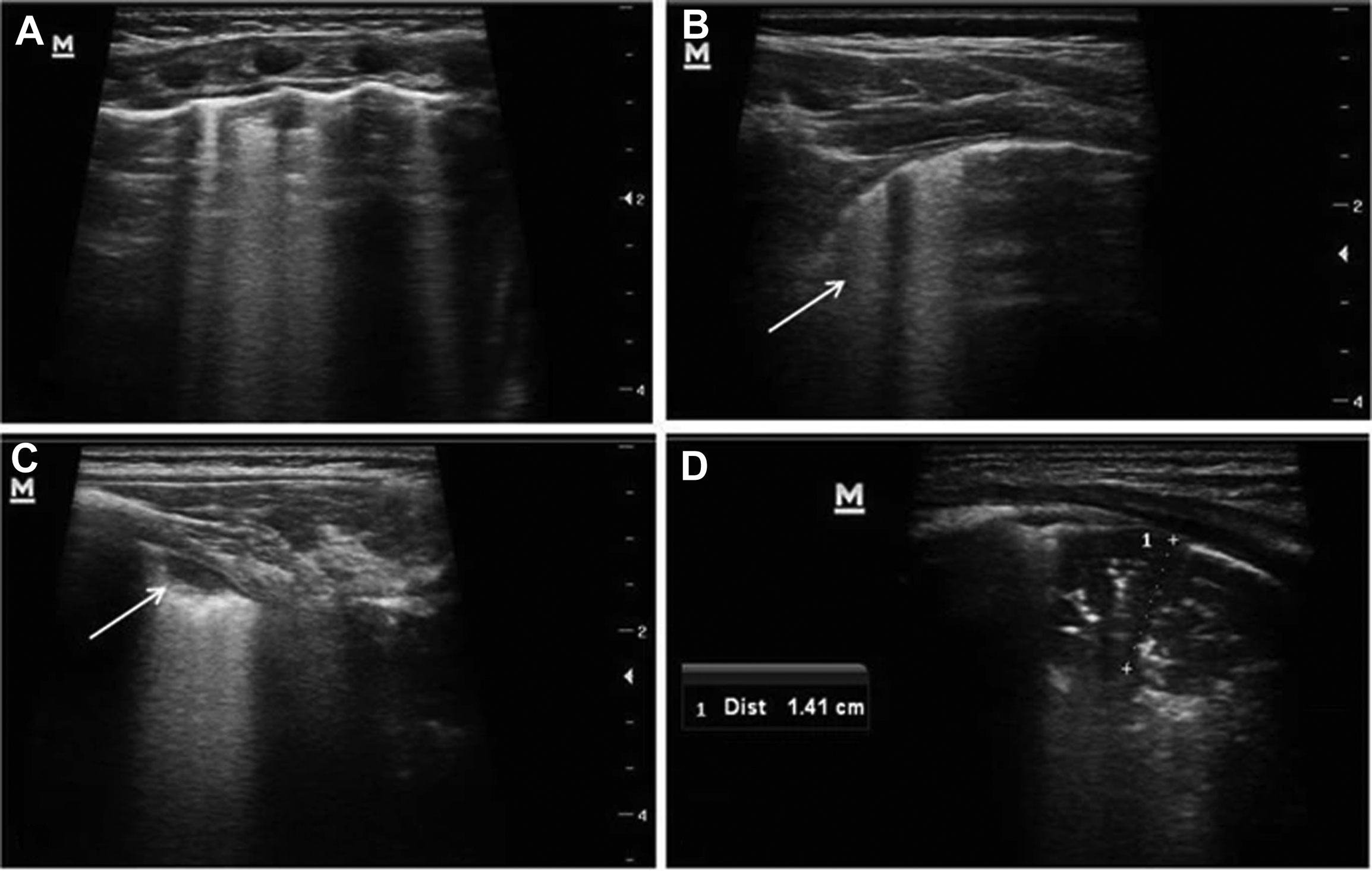 Cardiopulmonary Emergencies In Older Adults Anesthesia Key