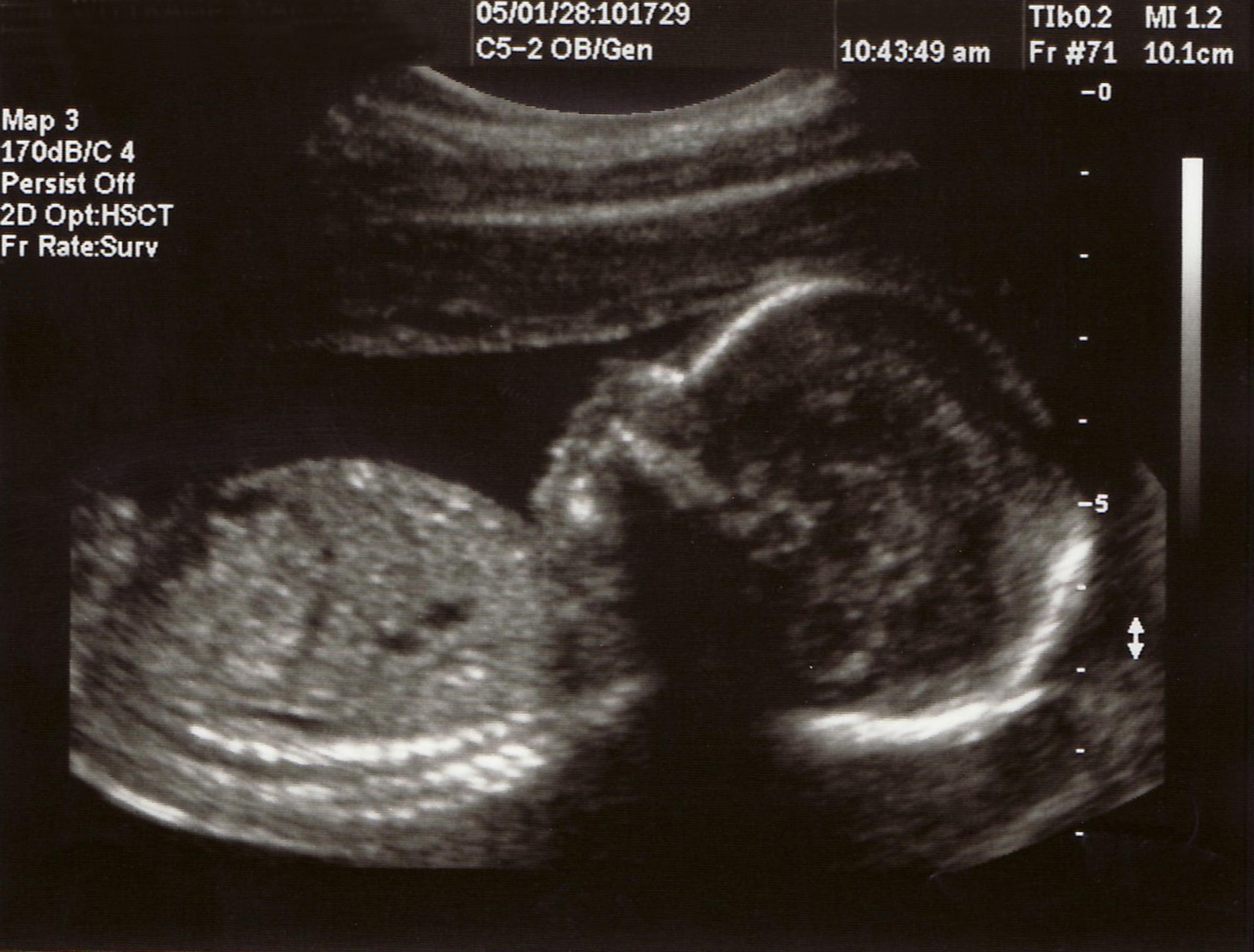 After you complete step one of the registration process, you will have access to limited tax information on my account. Human Chimera: How a Man's Unborn Twin Fathered His Child