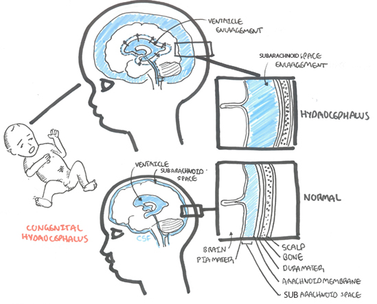 Learn how to sign up for snapchat. Hydrocephalus Armando Hasudungan