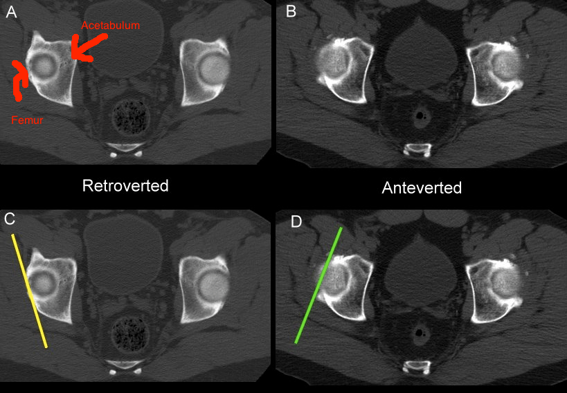 Anteversion And Retroversion Of Hip – WHROEU