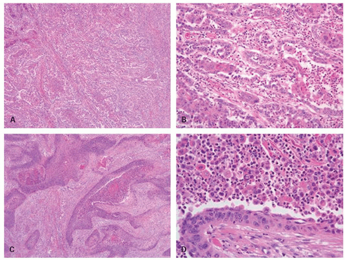 Polyps and Tumors of the Esophagus Basicmedical Key