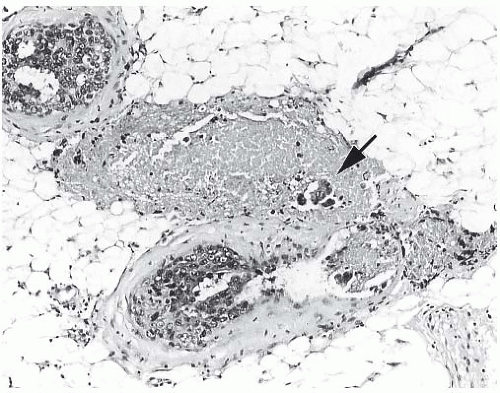 Ductal Carcinoma In Situ Basicmedical Key