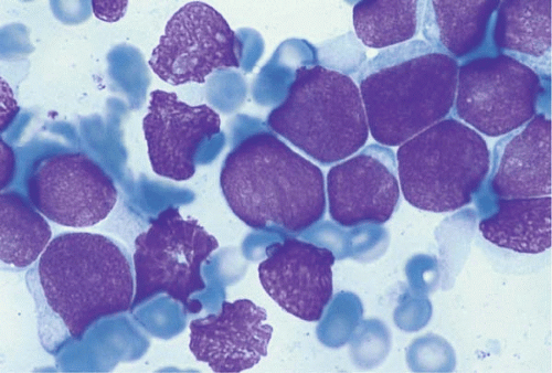 Precursor Lymphoid Neoplasms | Basicmedical Key