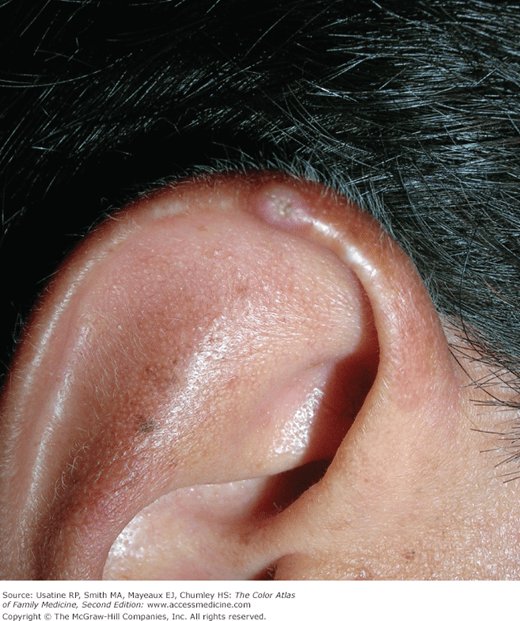 Learn what to expect if you have prostate cancer. Chondrodermatitis Nodularis Helicis and Preauricular Tags