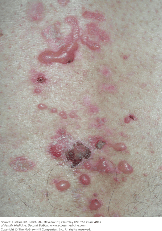 Localized bullous pemphigoid.: bullous pemphigoid treatment – ICDK
