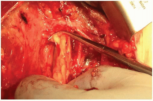 Axillary Lymph Node Dissection for Melanoma | Basicmedical Key