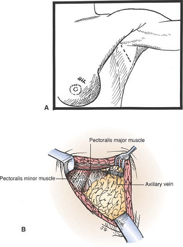 Axillary Node Biopsy and Axillary Node Dissection | Basicmedical Key