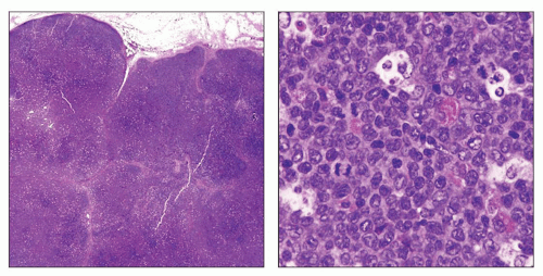 Kikuchi-Fujimoto Disease | Basicmedical Key