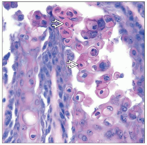 Events and seminars hosted and/or organised by the idm are indexed on the respective idm calendars. Warty Dyskeratoma | Basicmedical Key