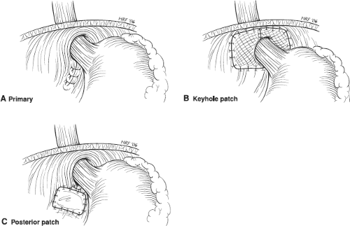 Open Paraesophageal Hernia Repair | Basicmedical Key