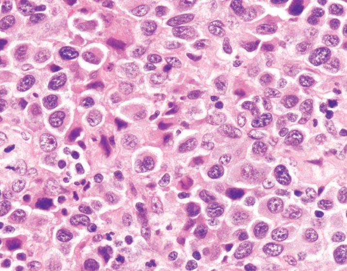 Hematopathology: Lymph Node and Spleen | Basicmedical Key