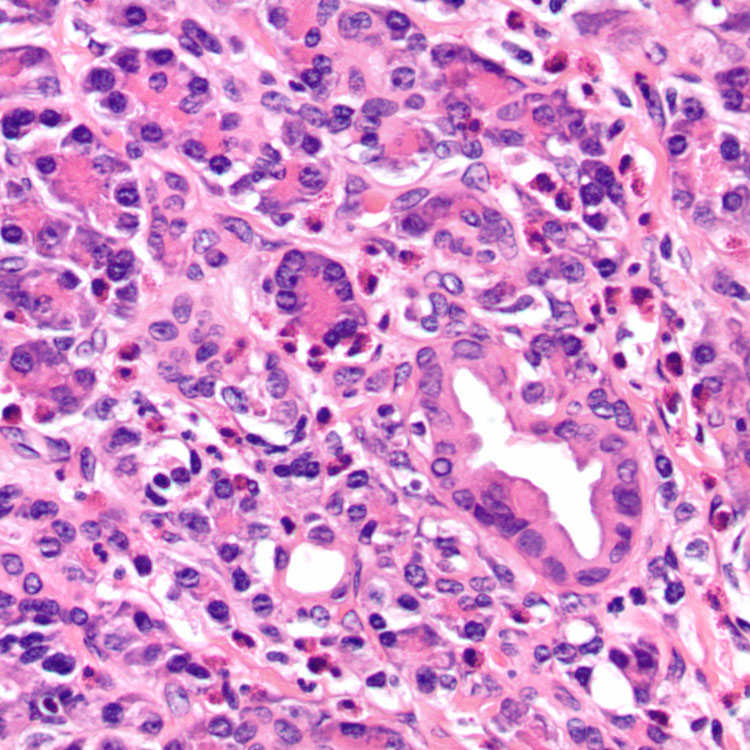 Chronic Pancreatitis Basicmedical Key