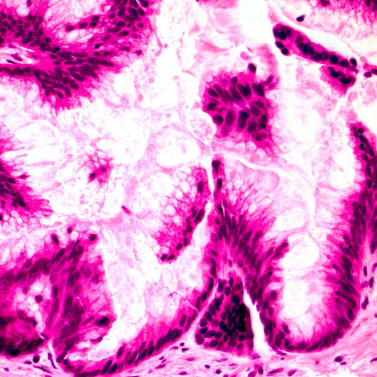 Intraductal Papillary Mucinous Neoplasm | Basicmedical Key