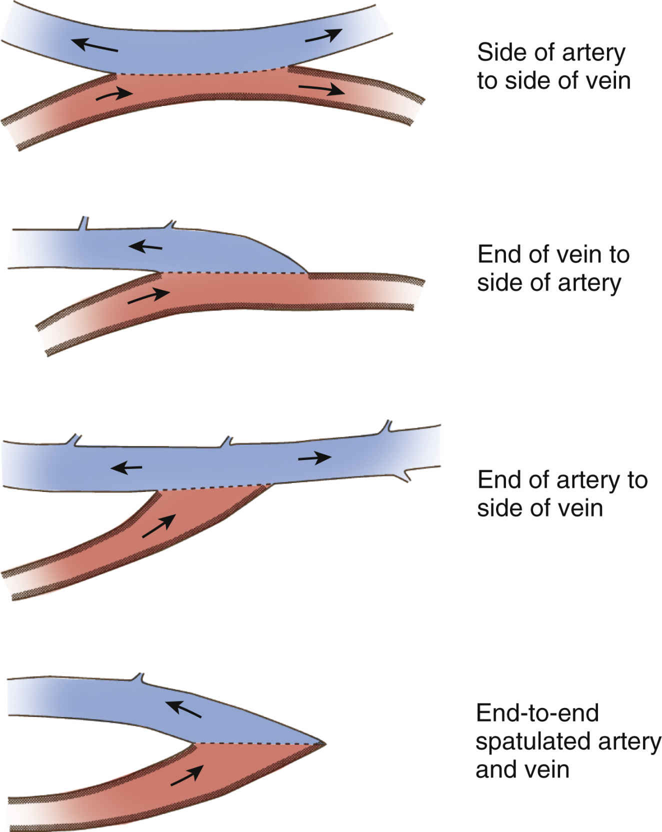 Vascular Surgery Basicmedical Key