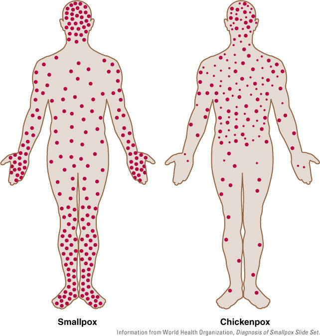 Smallpox Classification Poxviruses | Basicmedical Key