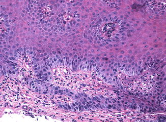 Squamous Intraepithelial Lesions of the Vulva | Basicmedical Key