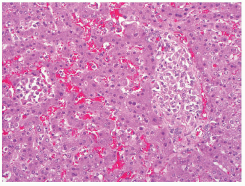 Granulomatous Liver Disease | Basicmedical Key