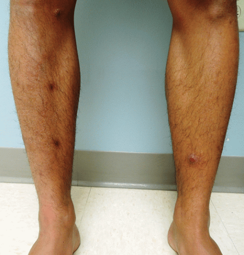 Primary Cutaneous CD30+ T-Cell Lymphoproliferative Disorders ...