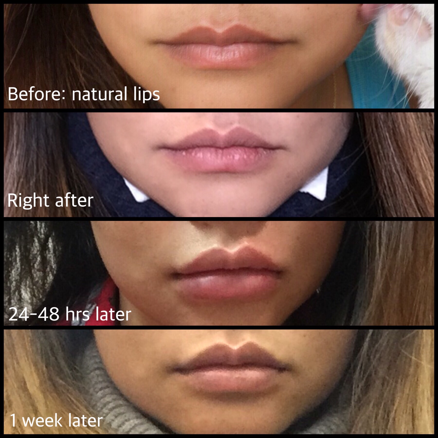 Doft noted that most of her patients return every six months, but that she tends to inject less . A Little Lip N Tuck My Restylane Lip Filler Beautyandthecat S Beauty Blog