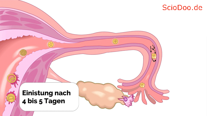 Die befruchtete eizelle wird durch die eileiter zur . Das Datum fÃ¼r den Eisprung, Befruchtung, Einnistung und